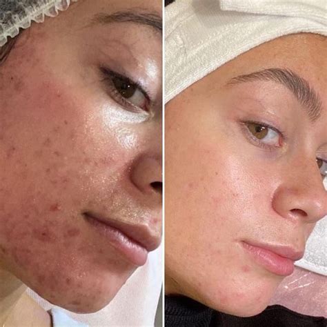 Before And After Hydrafacial Berman Skin Institute