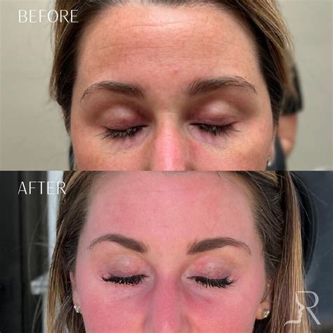 Before And After Zo Skin Health Procedures In Houma La Roberts