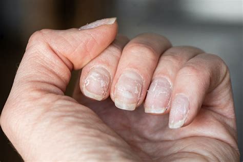 Funky Fingertips What Nails Say About Your Health The Island News
