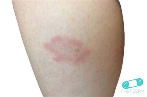 Lyme Disease Online Dermatology
