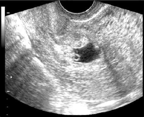 Transvaginal Ultrasound Shows A Gestational Sac With An Irregular