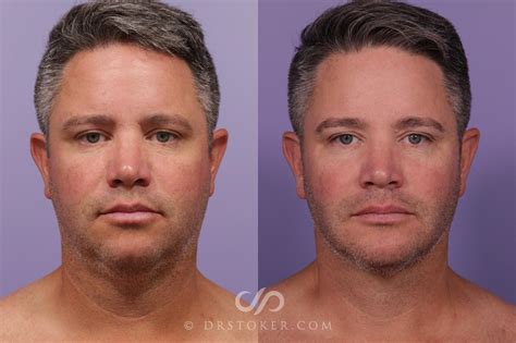 Buccal Fat Removal Avieranulf
