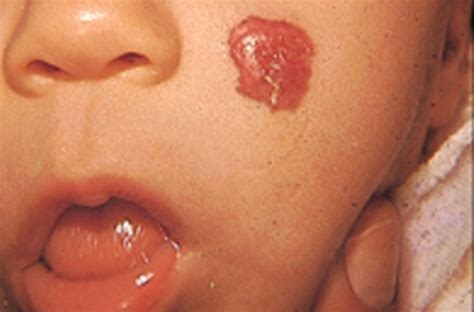 Hemangioma Of Skin Strawberry Hemangioma