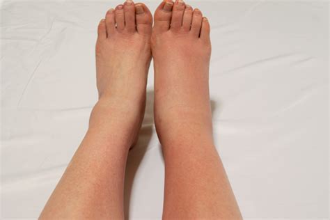 What To Do For Prolonged Swelling In The Legs Doctors To Visit