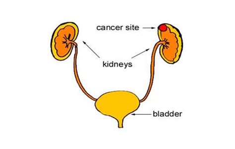 The Early Signs Of Kidney Cancer Health Changing