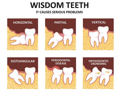 Wisdom Teeth Why We Have Them And When To Remove Them Hamburg Dental
