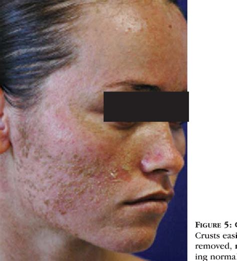 Figure 1 From Dermatosis Neglecta A Report Of Two Cases Semantic