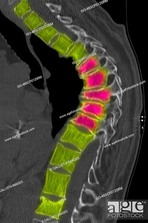 Ct Scan Of Thoracic Spine With Osteoporosis Stock Photo Picture And