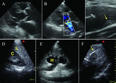 Point Of Care Cardiac Ultrasound Techniques In The Physical Examination