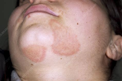 Tinea Fungal Infection On The Face Stock Image C Science