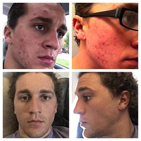 Accutane Before And After Pictures Couldnt Have Asked For Better