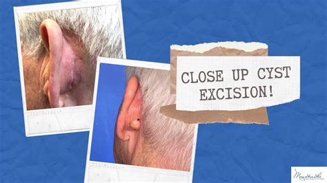 Ear Pain As Related To Benign Ear Cyst Or Tumor Pictures