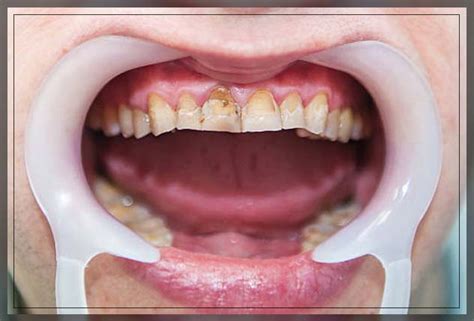 Dental Fluorosis Types And Treatment Dentist Ahmed Official Website