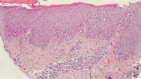 Atopic Dermatitis Immune Response And Skin Lesions Qima Life Sciences