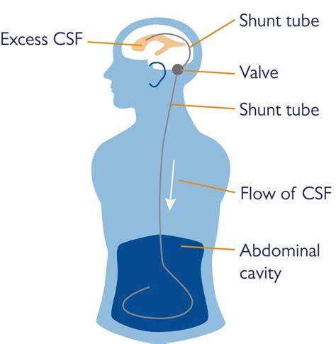 Shunts And Visiting An Audiology Clinic The Hearing Clinic