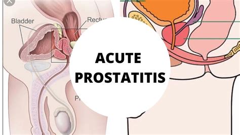What Is Acute Prostatitis Part Made Simple Etiology Symptoms And Diagnosis Youtube