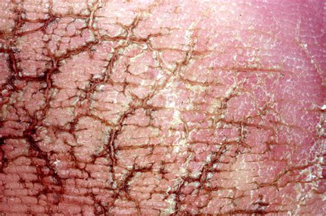 Calloused And Fissured Skin Stock Image M3150028 Science Photo