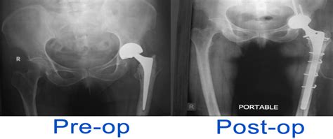 Conversion Of Bipolar To Total Hip Replacement Sant Parmanand Hospital