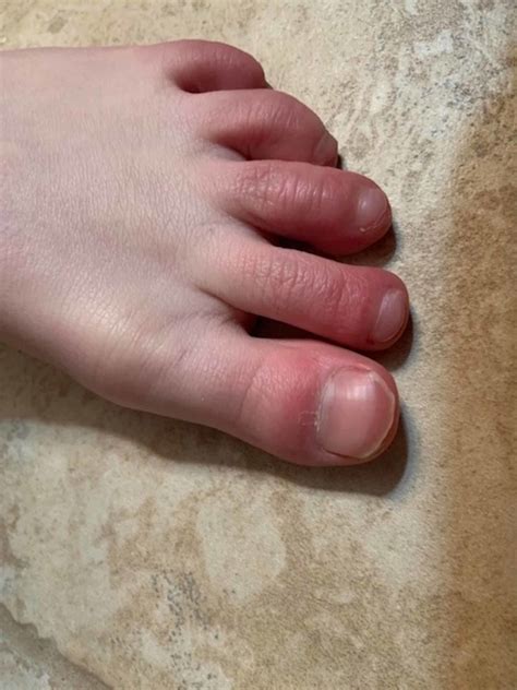 Cureus Chilblains In Covid 19 Infection