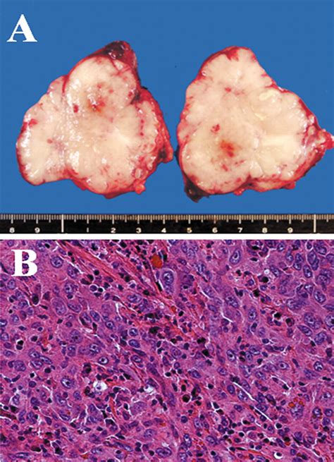 Resection Of Solitary Metachronous Lymph Node Metastasis From