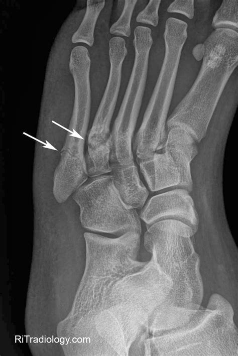 Pain on top of your foot: RiT radiology: April 2014