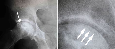 Diagnosis of acute avascular necrosis. Osteonecrosis of the Hip - OrthoInfo - AAOS