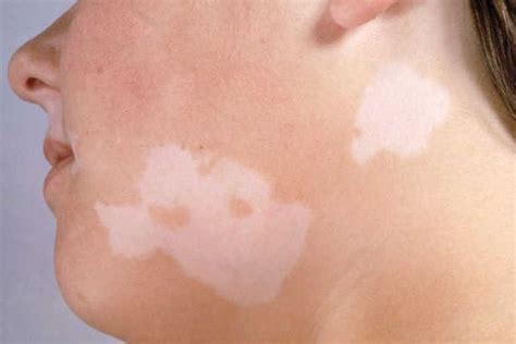 What Causes White Spots On The Skin Dr Amit Kumar Paras Hmri