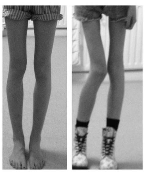 a oto różnica po między nogami chudymi i ładnymi a nogami anor na