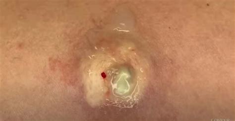 Squeezing Boils New Pimple Popping Videos