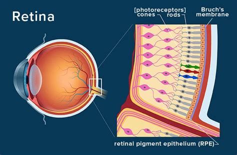 Angioid Streaks Of The Retina