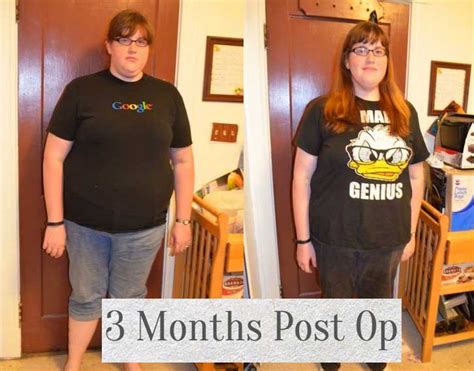 3 Months Before And After Gastric Bypass Obesity Coverage