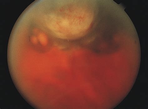 Acquired Tumors Arising From Congenital Hypertrophy Of The Retinal