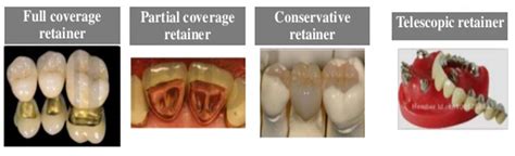 Fixed Partial Dentures Part 1 Focus Dentistry