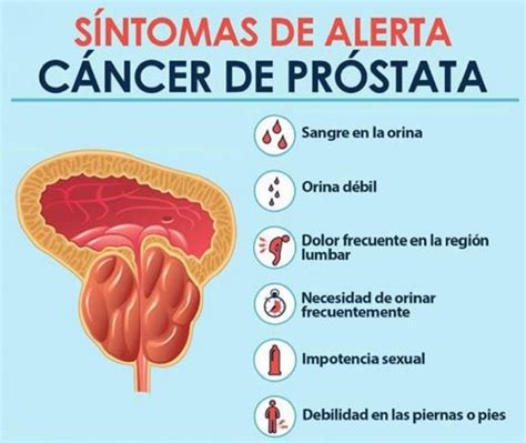 Sintético 97 Foto 14 Remedios Caseros Para La Prostata Inflamada Alta