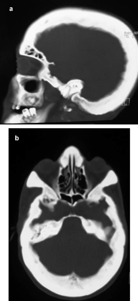 A And B Ct Skull Coronal And Axial View Thickened Skull Vault And
