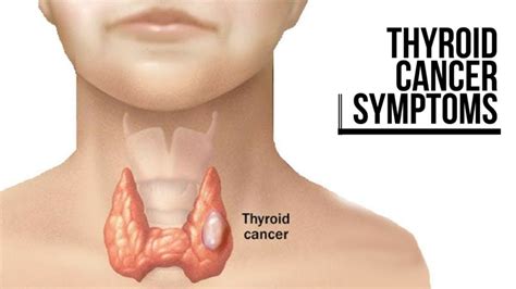 Metastatic squamous neck cancer with occult primary treatment. Thyroid Cancer: Symptoms, Types, Causes And Treatment Overview