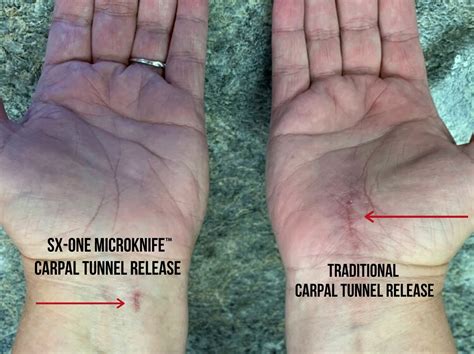 Carpal Tunnel Release In2it Medical