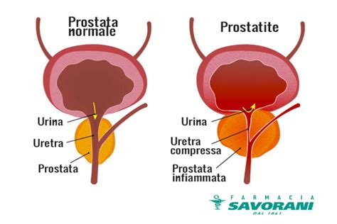 Prostatite Sintomi Cause E Cure Farmaciasavorani