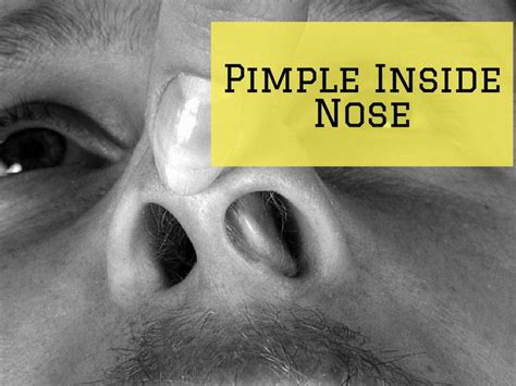 Pimple Inside Nose Causes Symptoms And Treatments
