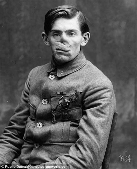 Before And After Photographs Show Wwi Soldiers Injuries