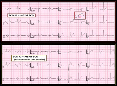 In pericarditis, this saddle shape is characteristically seen globally throughout the ecg. Dr. Smith's ECG Blog: Saddleback ST Elevation. Is it STEMI ...