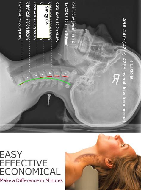 How We Fix Necks And Improve Posture