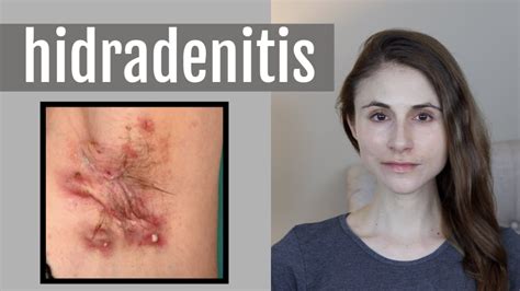 Hidradenitis Suppurativa Q A With Dermatologist Dr Dray Youtube