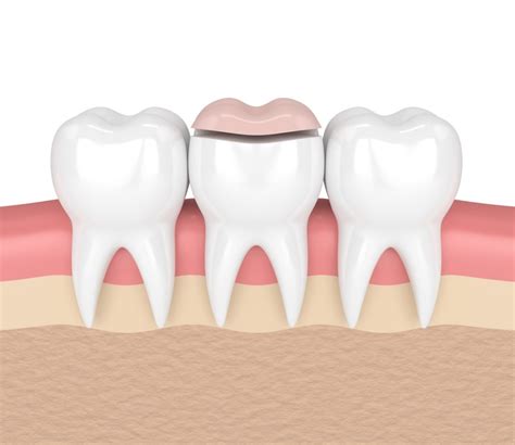 Dental Inlays And Onlays Drum Hill Dental Chelmsford Ma