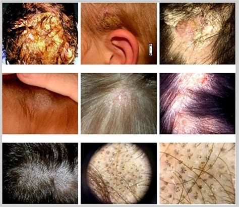 Fungal Infection Of The Scalp Tinea Capitis Causes Risk Factors