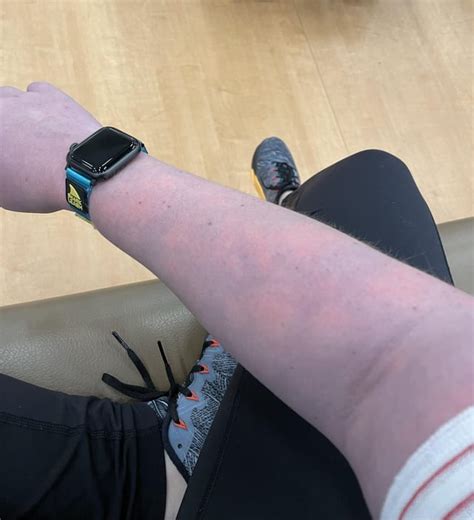 I Have A Vascular Issue Which Makes My Arms Turn Purple And Orange When