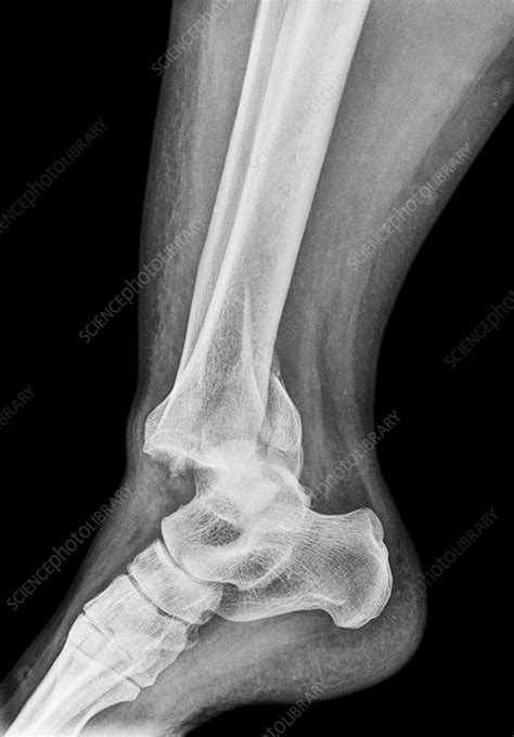 Fractured Ankle Bones X Ray Stock Image C0386656 Science Photo