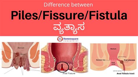 Difference Between Piles Fissure And Fistula In Kannada YouTube
