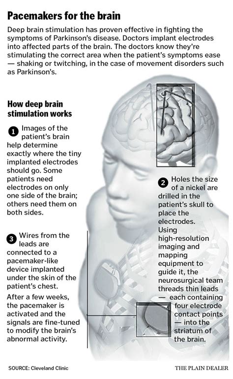 How Deep Brain Stimulation Is Used To Treat Parkinsons Disease