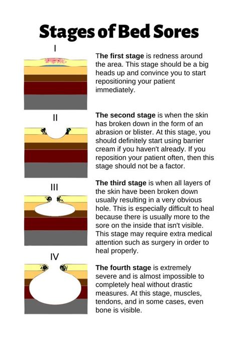 Stages Of Bed Sores Chart Poster By Caregiverology In 2022 Bed Sores